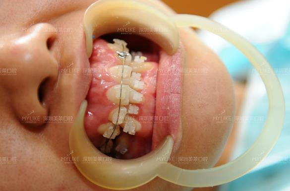 真人案例冰晶半隐形