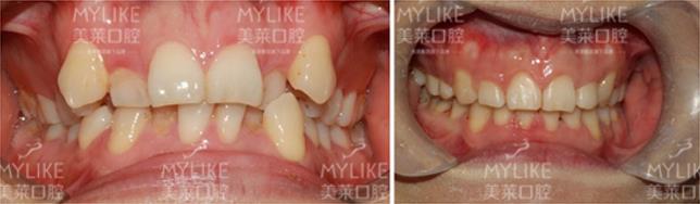 冰晶半隐形矫正