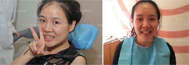 冰晶半隐形矫正